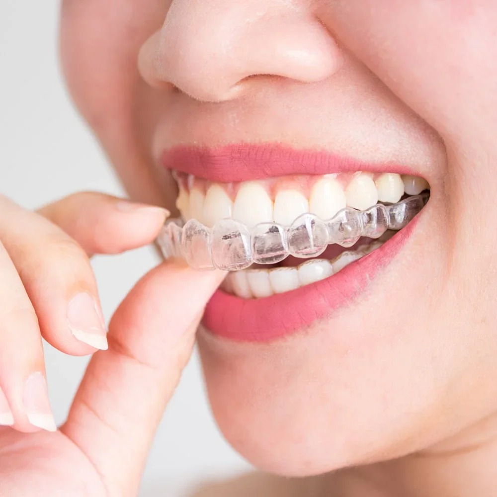 Teeth Whitening Mouth Guard - 1-4 unidades Protector bucal antirronquidos y