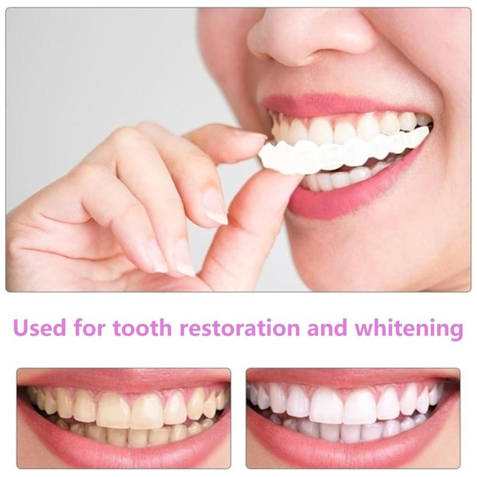 Cubiertas Dentales Superiores  - Teeth Whitening With Braces reseña y precio