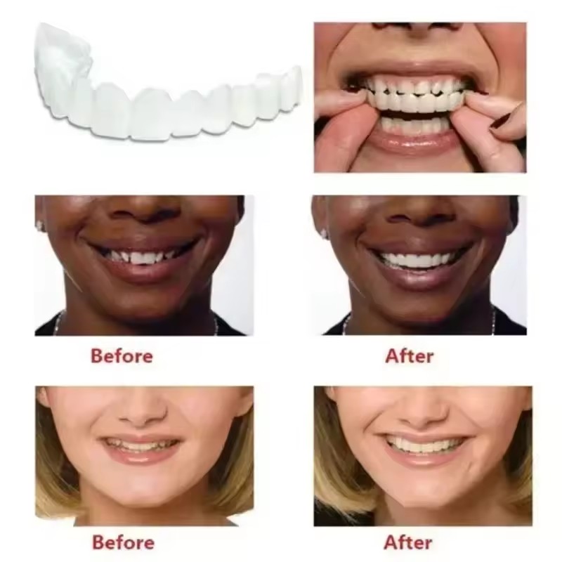 Carillas Dentales, Blanqueamie - Teeth Whitening With Braces reseña y precio