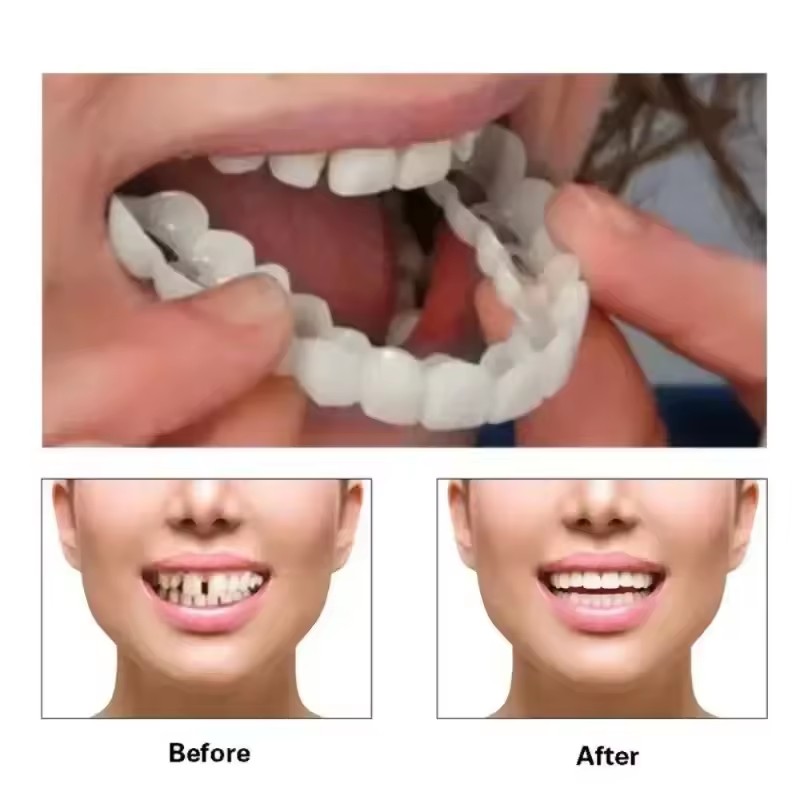 Carillas Dentales, Blanqueamie - Teeth Whitening With Braces reseña y precio