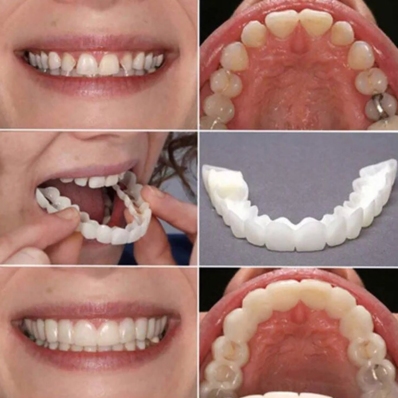 Carillas Dentales Blanqueadora - Teeth Whitening With Braces reseña y precio