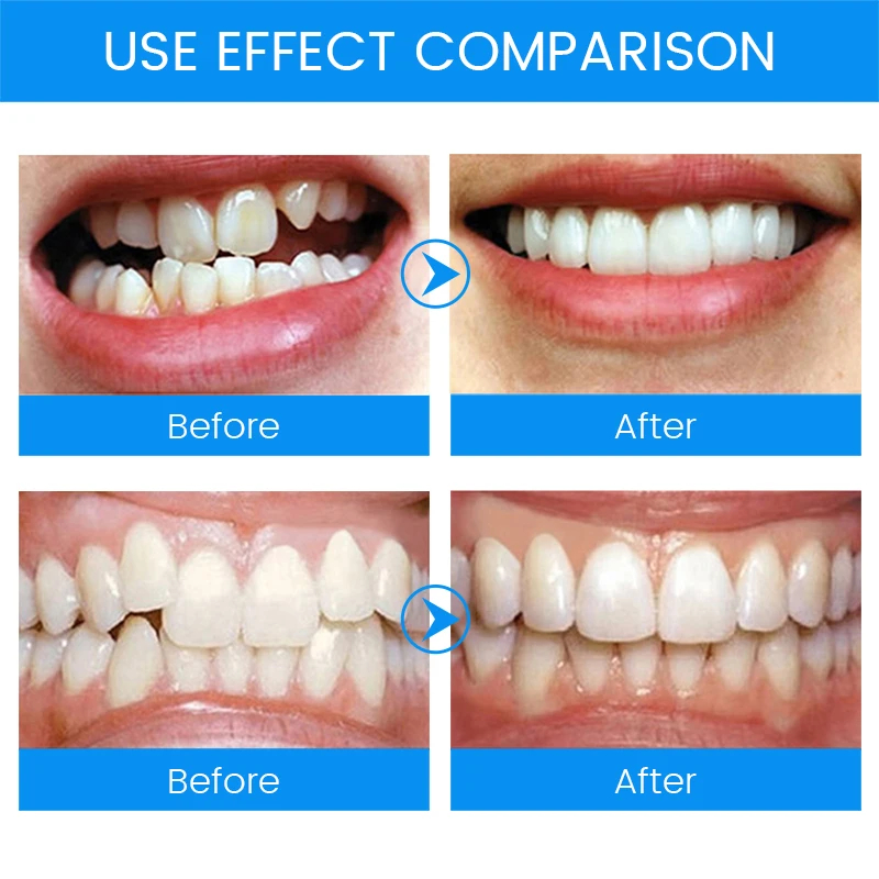 Aparatos de ortodoncia Dental  - Teeth Whitening Mouth Guard reseña y precio